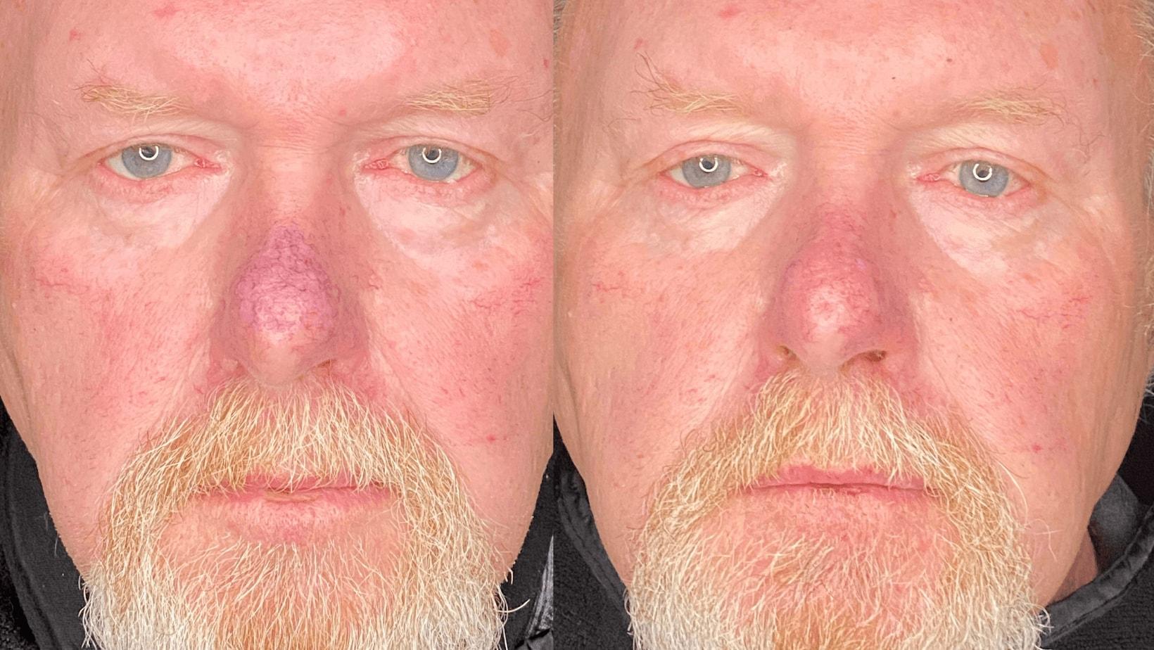 Milwaukee Laser & Body Aesthetics photofacial result — Brookfield, WI