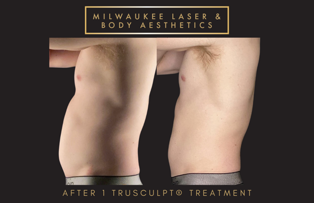 CoolSculpting result at Milwaukee Laser & Body Aesthetics in Brookfield, WI