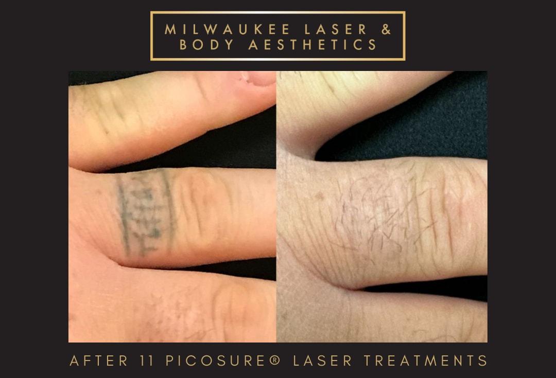 Milwaukee Laser & Body Aesthetics laser treatment result — Brookfield, WI