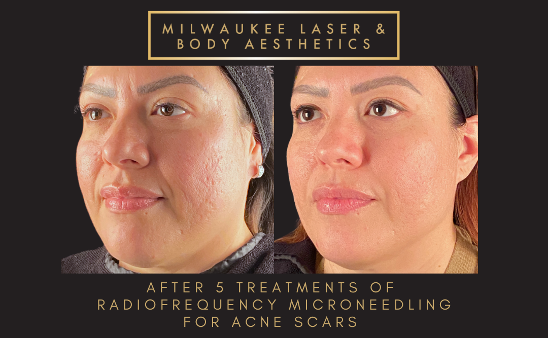 Milwaukee Laser & Body Aesthetics result — Brookfield, WI