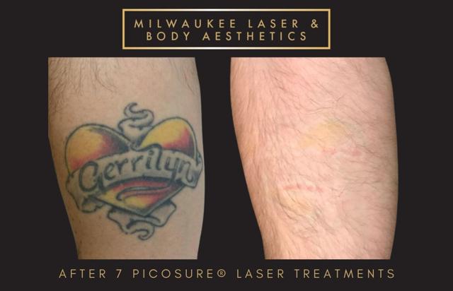 Laser Skin Resurfacing result at Milwaukee Laser & Body Aesthetics in Brookfield, WI