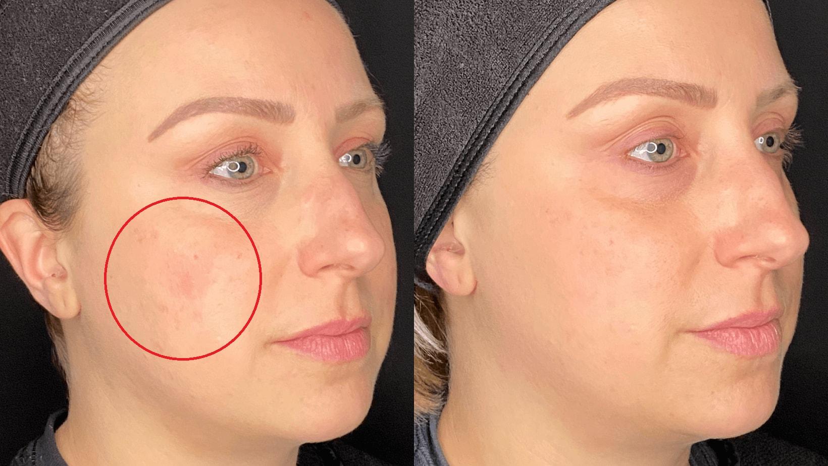 Milwaukee Laser & Body Aesthetics photofacial result — Brookfield, WI