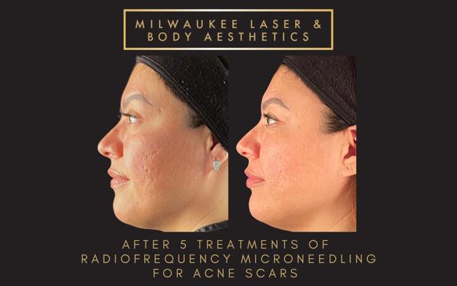 Microneedling result at Milwaukee Laser & Body Aesthetics in Brookfield, WI
