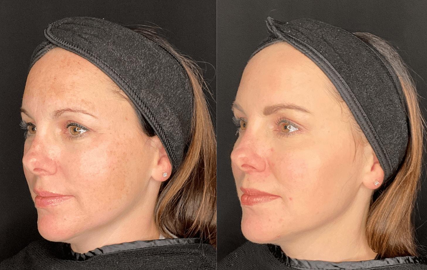 Milwaukee Laser & Body Aesthetics photofacial result — Brookfield, WI
