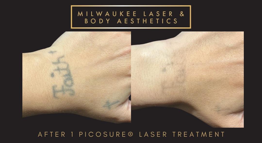 Milwaukee Laser & Body Aesthetics laser treatment result — Brookfield, WI
