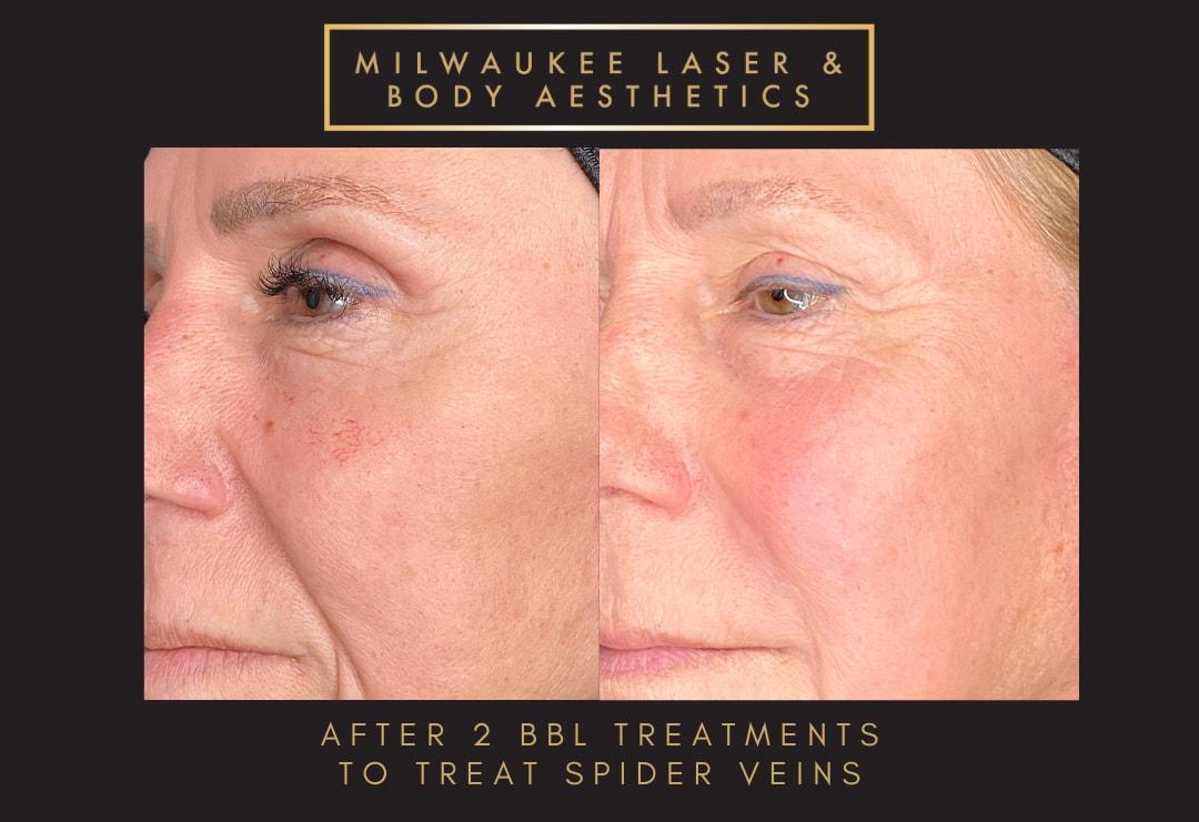 Milwaukee Laser & Body Aesthetics photofacial result — Brookfield, WI