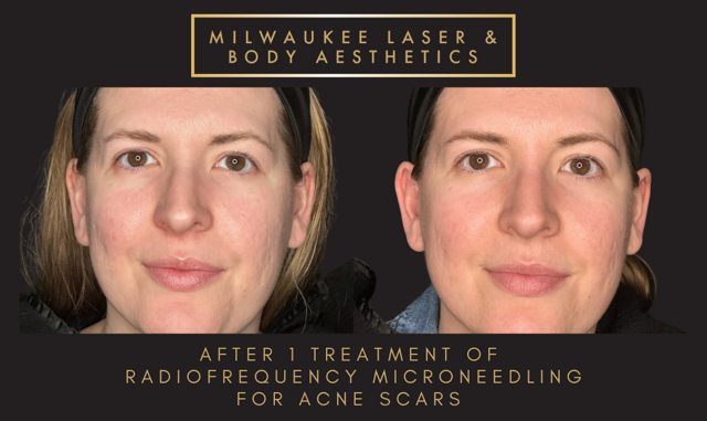 Morpheus8 result at Milwaukee Laser & Body Aesthetics in Brookfield, WI