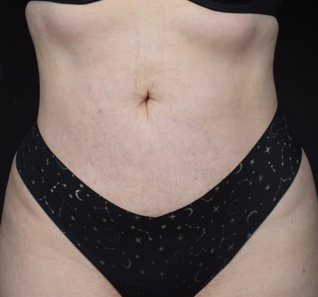 Samuel V. Bartholomew, MD, FACS liposuction after — Portland, OR