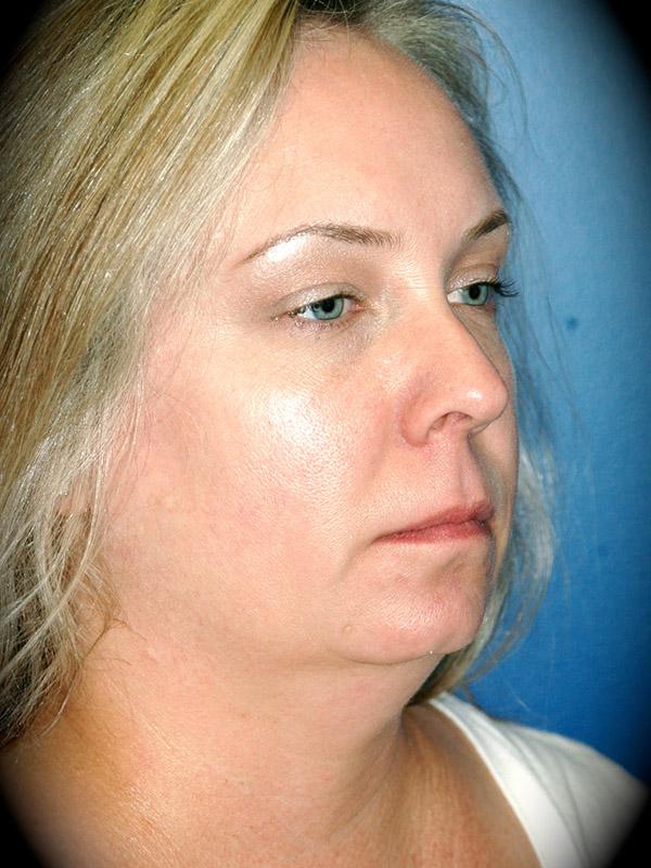 Liposuction before at Pasadena Cosmetic Surgery in Pasadena, CA