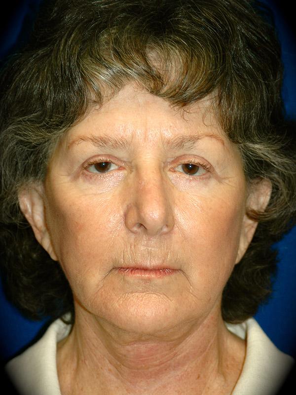 Deep Plane Facelift after at Pasadena Cosmetic Surgery in Pasadena, CA