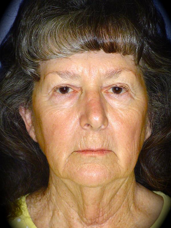 Deep Plane Facelift before at Pasadena Cosmetic Surgery in Pasadena, CA