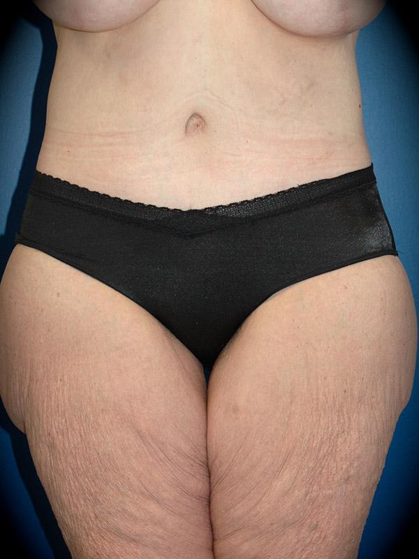 Mini Tummy Tuck after at Pasadena Cosmetic Surgery in Pasadena, CA