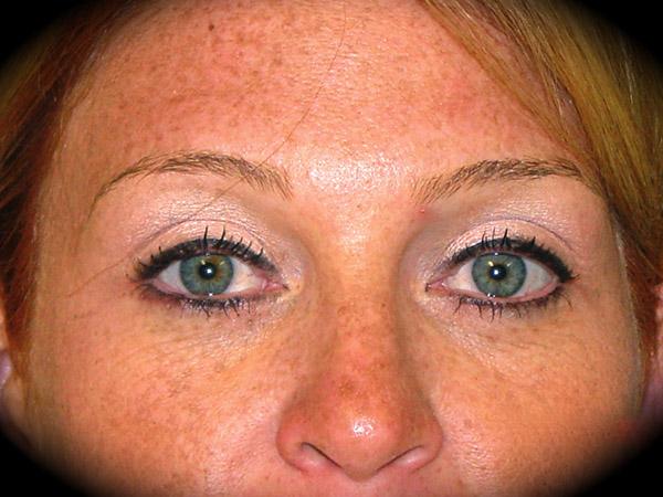Brow Lift after at Pasadena Cosmetic Surgery in Pasadena, CA