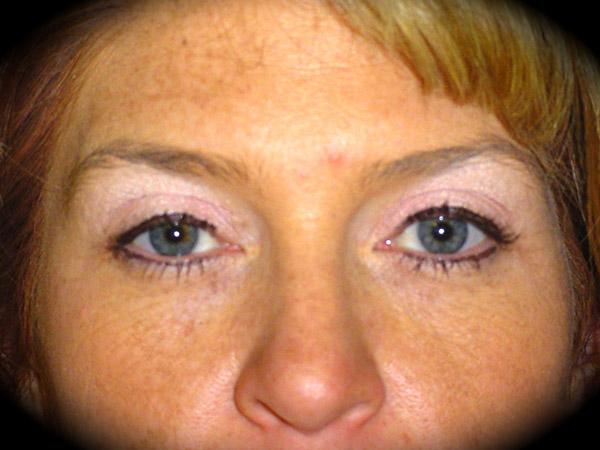 Brow Lift before at Pasadena Cosmetic Surgery in Pasadena, CA