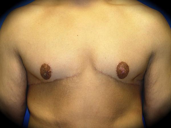 Pasadena Cosmetic Surgery gynecomastia after — Pasadena, CA