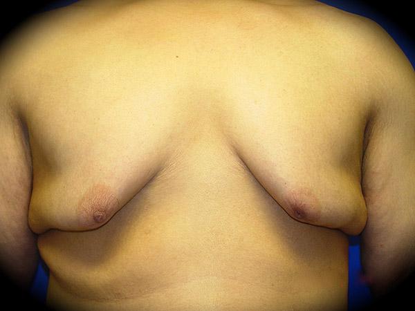 Gynecomastia Surgery before at Pasadena Cosmetic Surgery in Pasadena, CA