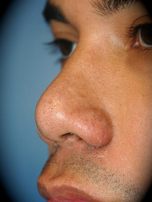 Pasadena Cosmetic Surgery rhinoplasty after — Pasadena, CA