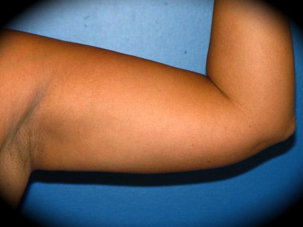 Liposuction after at Pasadena Cosmetic Surgery in Pasadena, CA