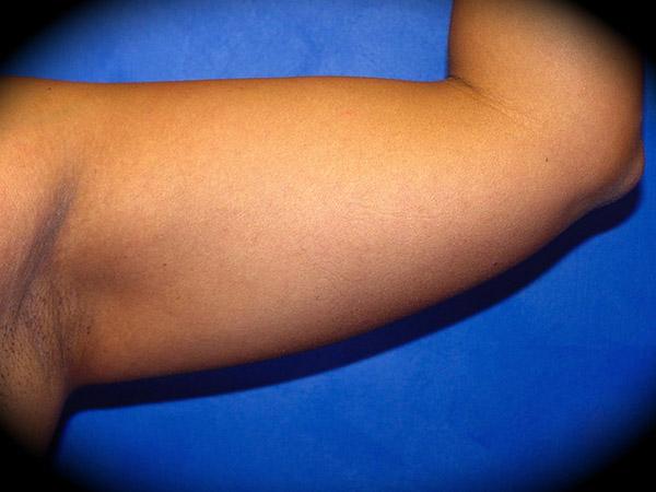 Liposuction before at Pasadena Cosmetic Surgery in Pasadena, CA