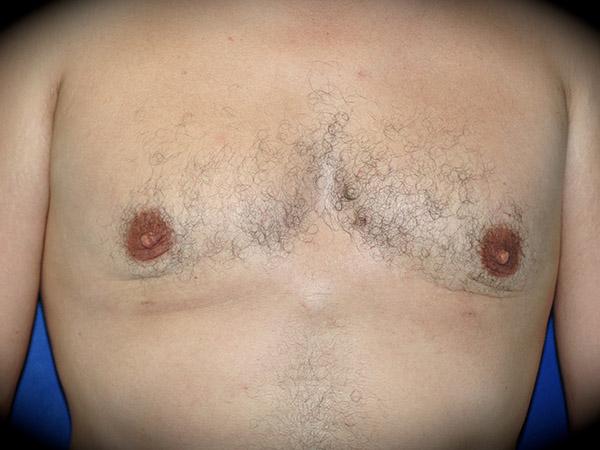 Pasadena Cosmetic Surgery gynecomastia after — Pasadena, CA
