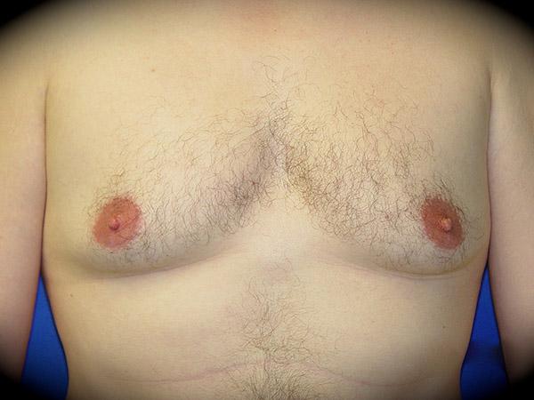 Gynecomastia Surgery before at Pasadena Cosmetic Surgery in Pasadena, CA