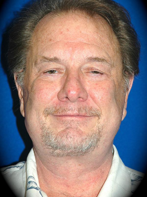 Neck Lift after at Pasadena Cosmetic Surgery in Pasadena, CA