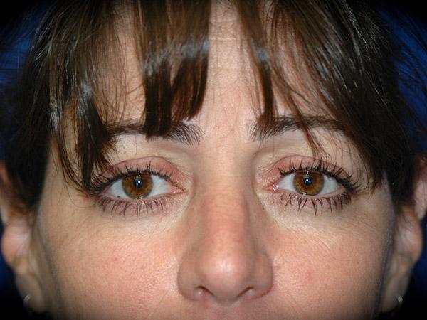 Brow Lift before at Pasadena Cosmetic Surgery in Pasadena, CA