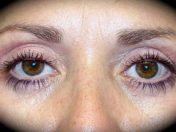 Blepharoplasty after at Pasadena Cosmetic Surgery in Pasadena, CA