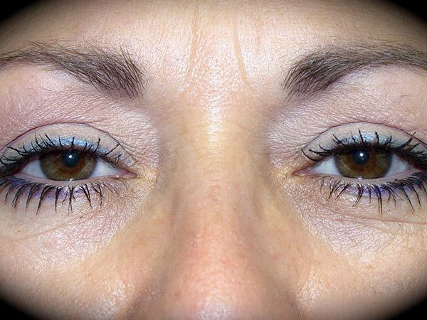 Blepharoplasty before at Pasadena Cosmetic Surgery in Pasadena, CA