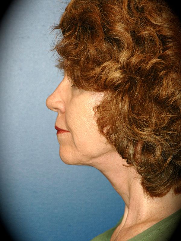 Neck Lift after at Pasadena Cosmetic Surgery in Pasadena, CA
