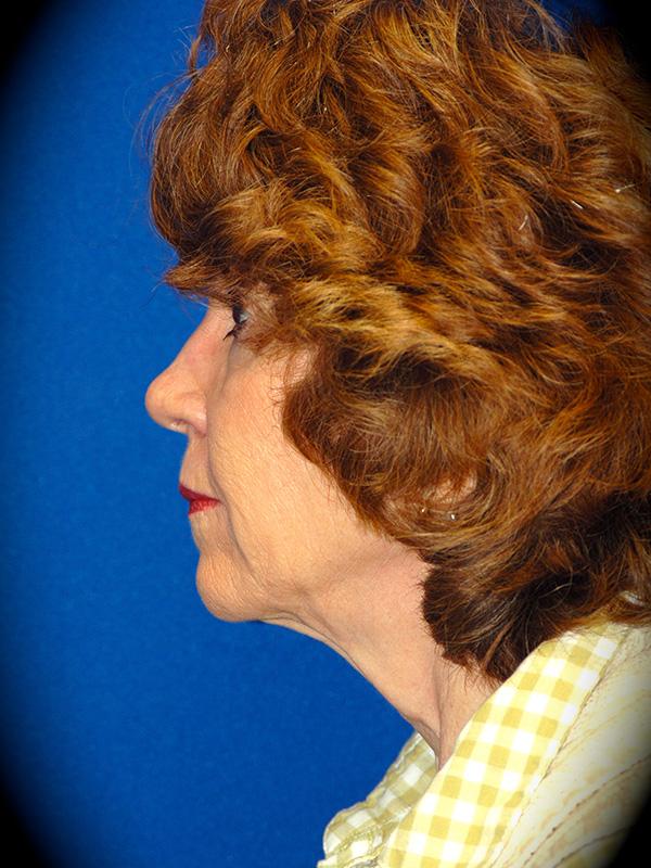Neck Lift before at Pasadena Cosmetic Surgery in Pasadena, CA