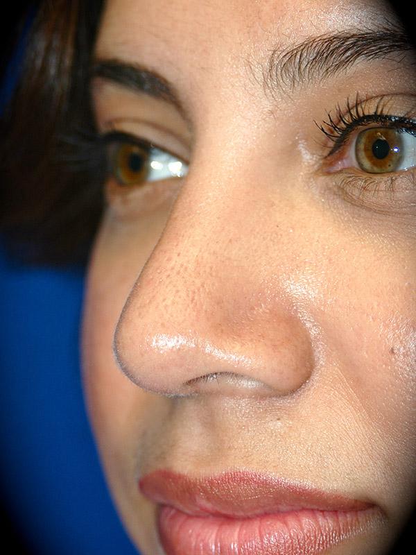 Pasadena Cosmetic Surgery rhinoplasty after — Pasadena, CA