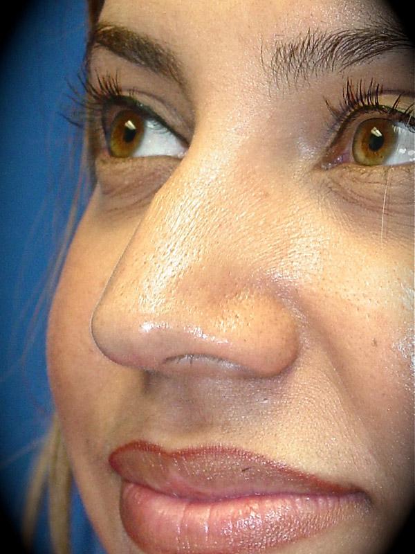 Rhinoplasty before at Pasadena Cosmetic Surgery in Pasadena, CA