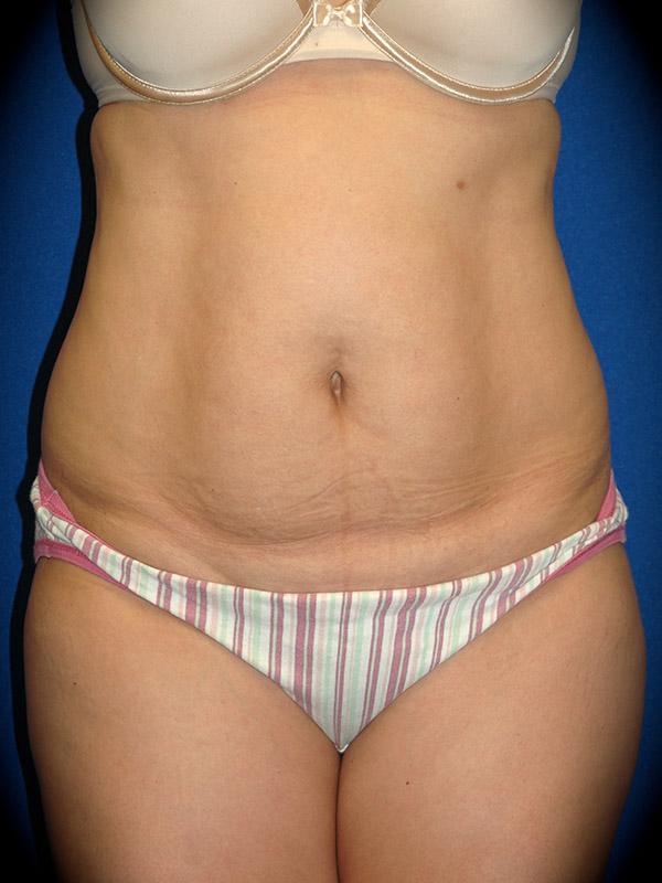 Liposuction before at Pasadena Cosmetic Surgery in Pasadena, CA