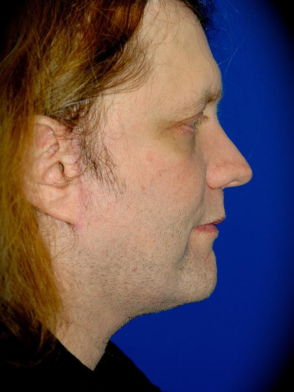 Neck Lift after at Pasadena Cosmetic Surgery in Pasadena, CA