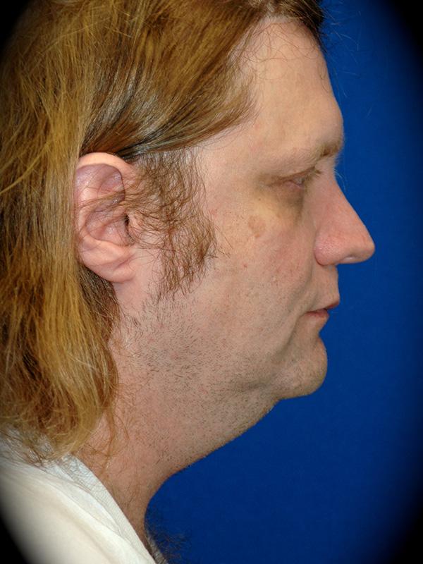 Neck Lift before at Pasadena Cosmetic Surgery in Pasadena, CA