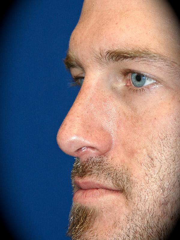Pasadena Cosmetic Surgery rhinoplasty after — Pasadena, CA