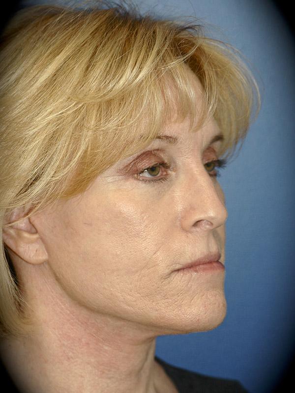 Laser Skin Resurfacing after at Pasadena Cosmetic Surgery in Pasadena, CA