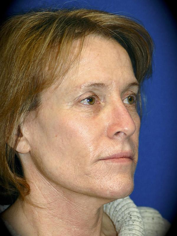 Laser Skin Resurfacing before at Pasadena Cosmetic Surgery in Pasadena, CA