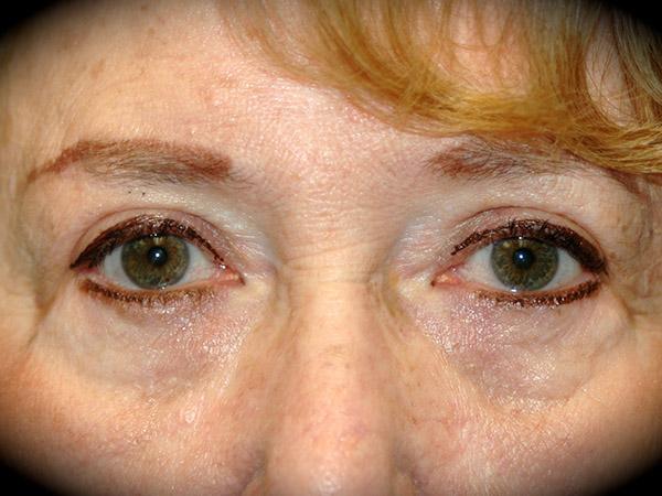 Brow Lift before at Pasadena Cosmetic Surgery in Pasadena, CA
