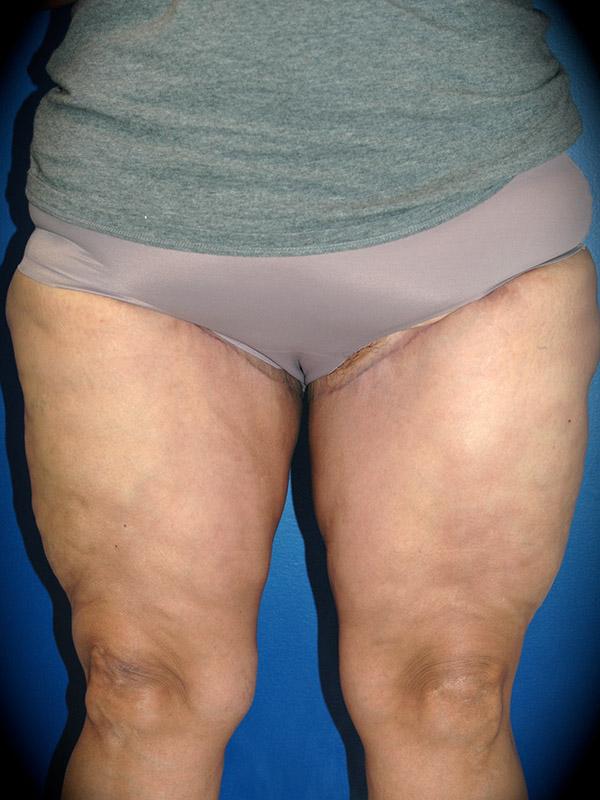 Thigh Lift after at Pasadena Cosmetic Surgery in Pasadena, CA