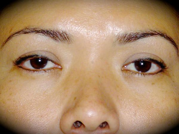 Blepharoplasty before at Pasadena Cosmetic Surgery in Pasadena, CA