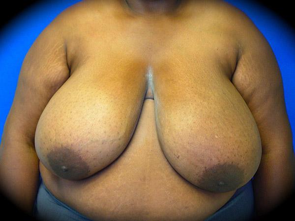 Breast Reduction before at Pasadena Cosmetic Surgery in Pasadena, CA