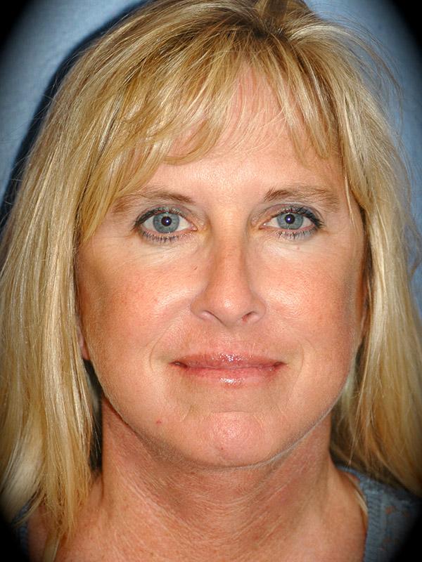 Laser Skin Resurfacing after at Pasadena Cosmetic Surgery in Pasadena, CA