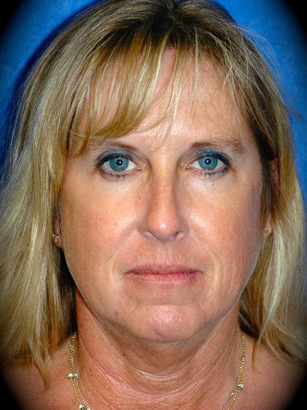 Laser Skin Resurfacing before at Pasadena Cosmetic Surgery in Pasadena, CA