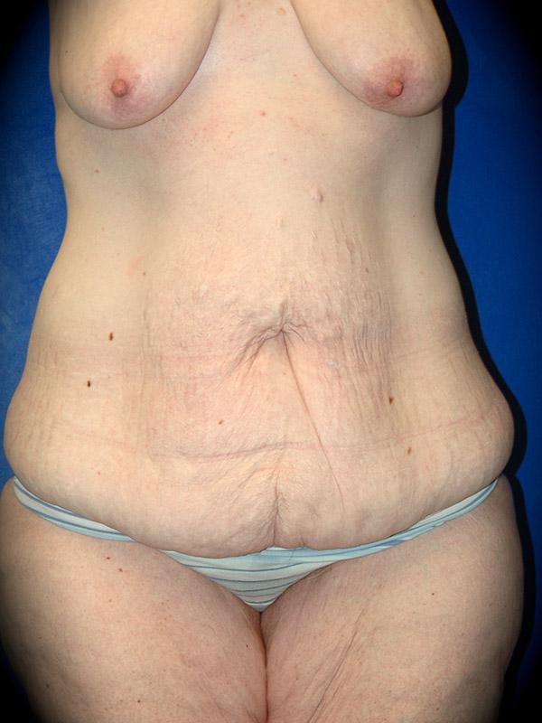 Mini Tummy Tuck before at Pasadena Cosmetic Surgery in Pasadena, CA