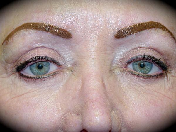 Blepharoplasty after at Pasadena Cosmetic Surgery in Pasadena, CA