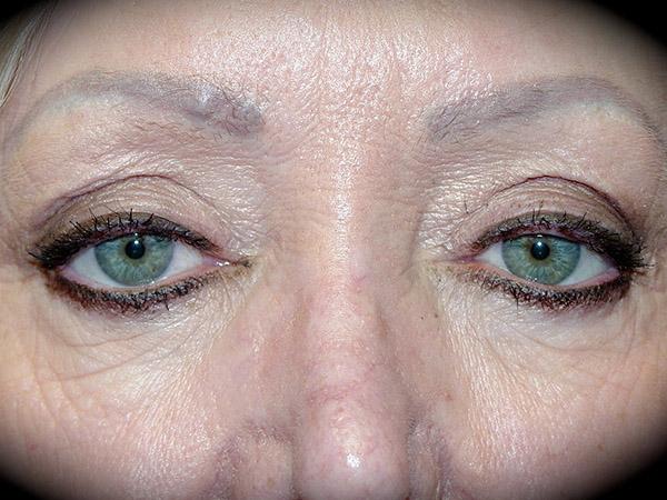 Blepharoplasty before at Pasadena Cosmetic Surgery in Pasadena, CA