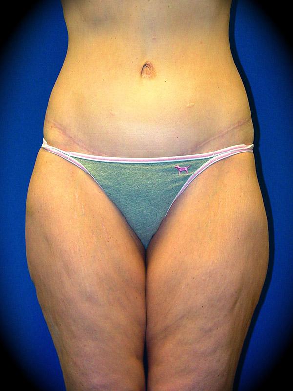 Thigh Lift before at Pasadena Cosmetic Surgery in Pasadena, CA