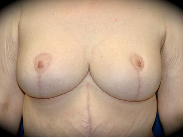 Breast Reduction after at Pasadena Cosmetic Surgery in Pasadena, CA